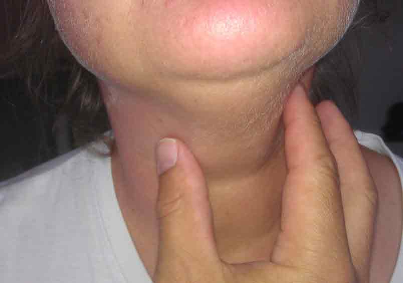 Hashimoto-Thyreoiditis - Symptome, Diagnose und Behandlung der Autoimmunerkrankung